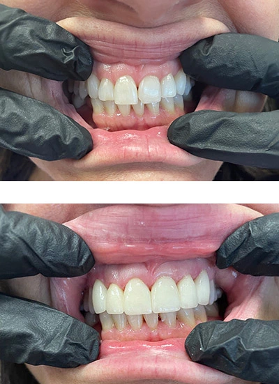 before and after photos of a smile makeover done at Desert Sage Family Dental