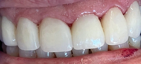 After image